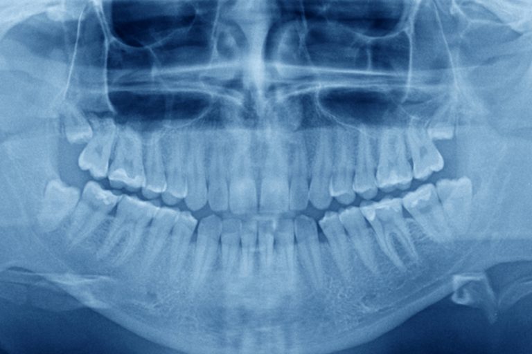 Panoramic Xray Natural Dental